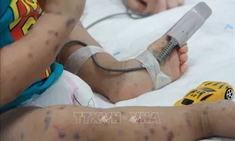 Hà Nội đã có 300 ca mắc tay chân miệng