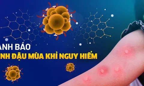 Người nhập cảnh từ nơi có dịch đậu mùa khỉ cần tự theo dõi sức khỏe