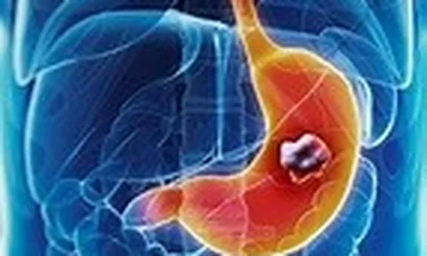 Ung thư dạ dày và những dấu hiệu cảnh báo bạn không nên bỏ qua
